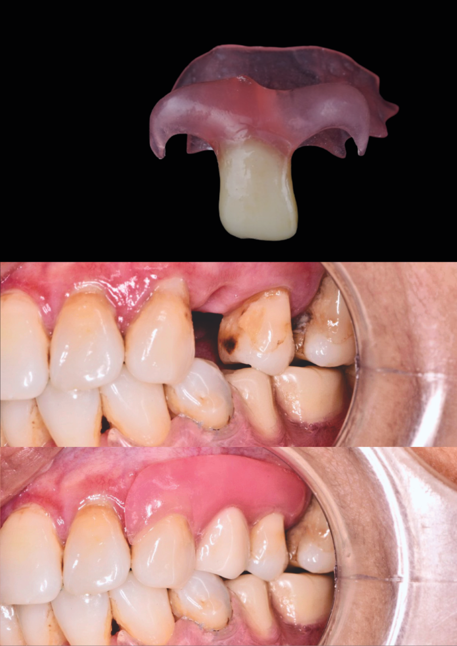 Flexible Denture