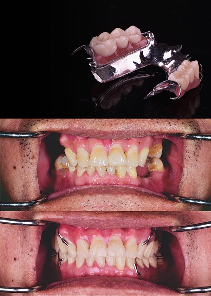 Frame Denture