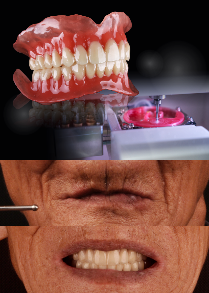 Full Denture