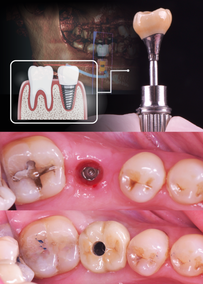 Implant