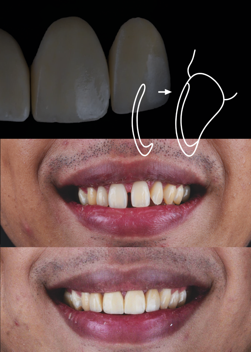 VENEER