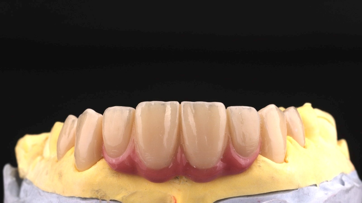 Denture vs Crown Gigi: Pilih yang Mana untuk Mengganti Gigi Hilang?