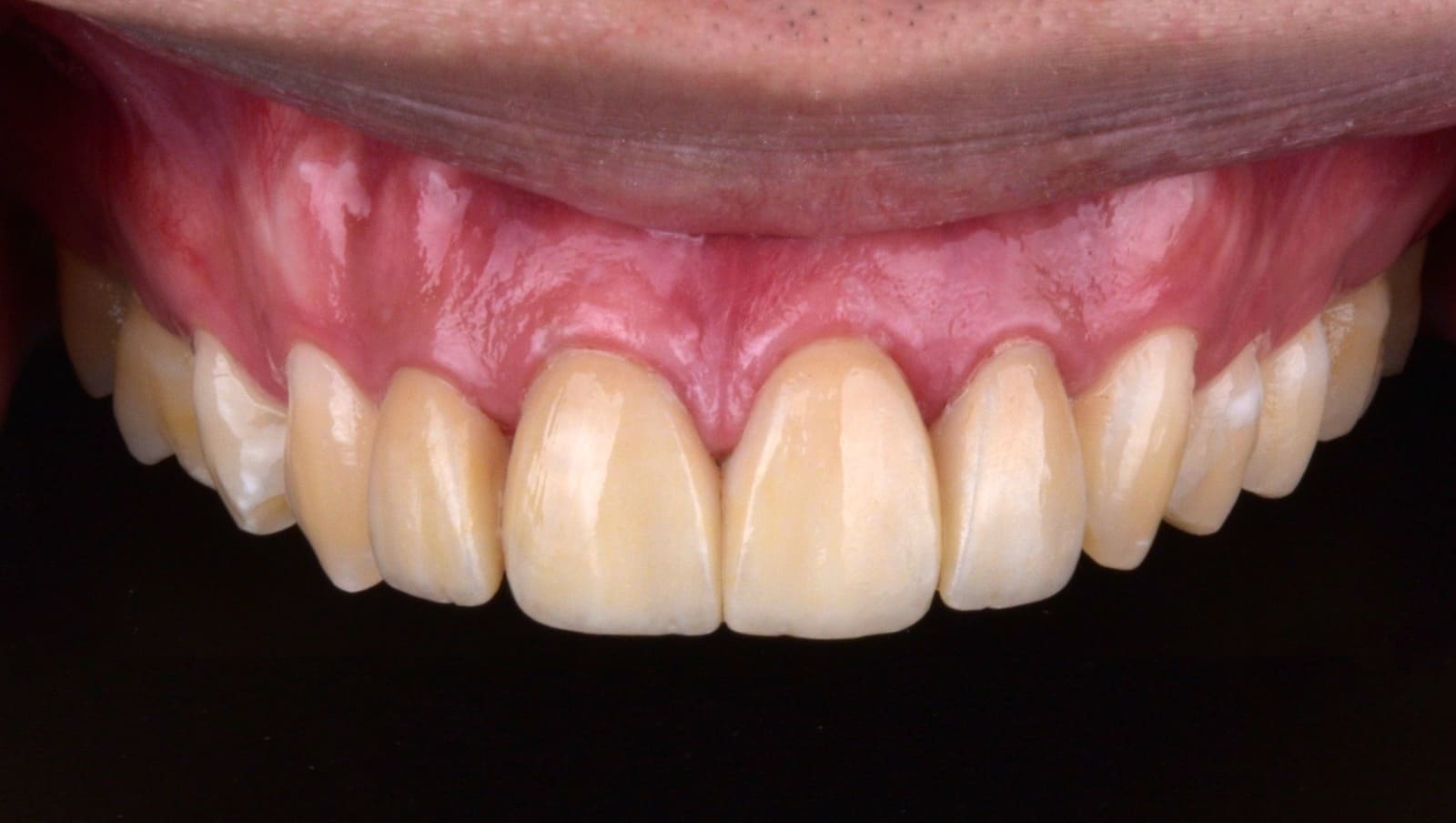 Perbedaan Crown Gigi dan Veneer: Mana yang Cocok untuk Anda?